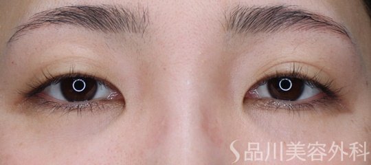 症例NO.69289のBEFORE写真