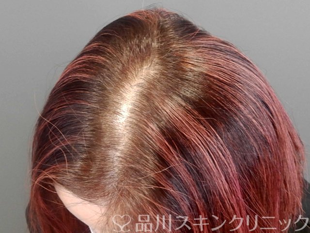 症例NO.69587のBEFORE写真