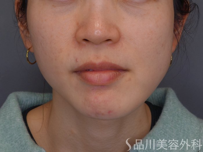 症例NO.74577のBEFORE写真