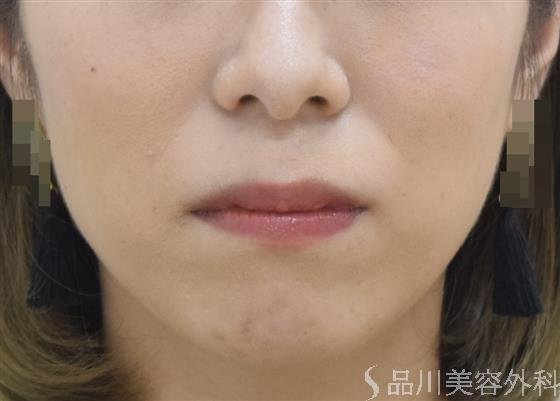 症例NO.42878のBEFORE写真