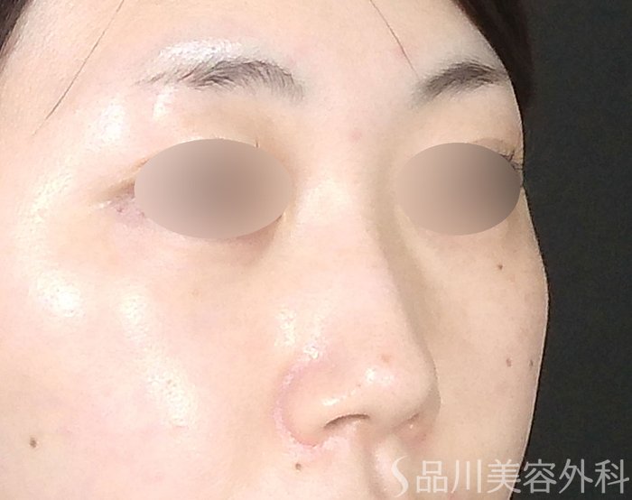 症例NO.70635のBEFORE写真