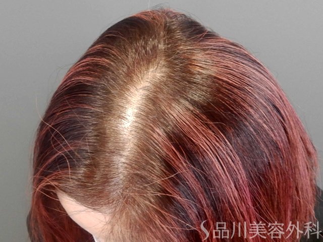 症例NO.69587のBEFORE写真
