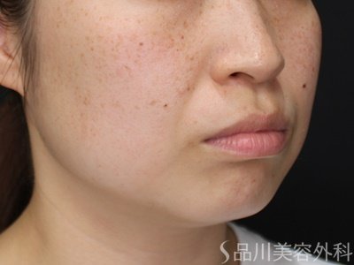 症例NO.71696のBEFORE写真
