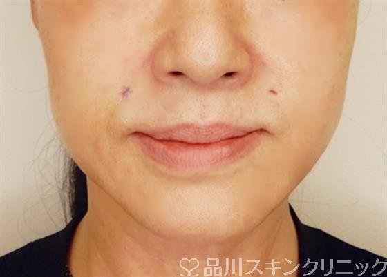 症例NO.51873のAFTER写真