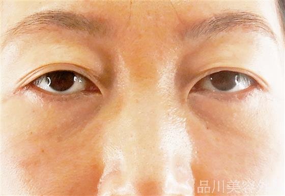 症例NO.56842のAFTER写真