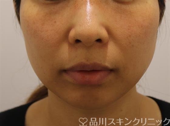 症例NO.44108のAFTER写真
