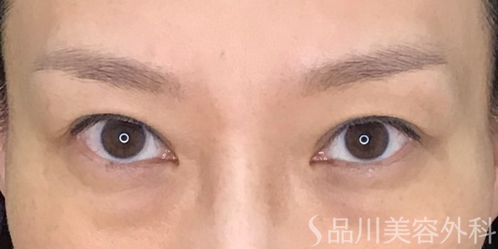 症例NO.70242のAFTER写真