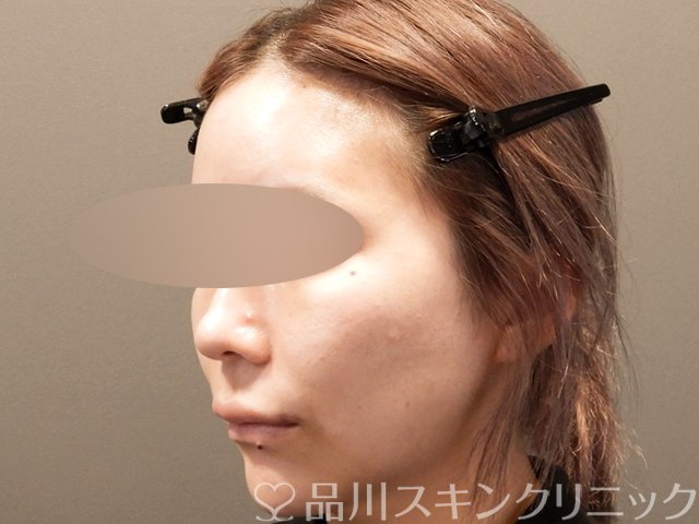 症例NO.67863のBEFORE写真