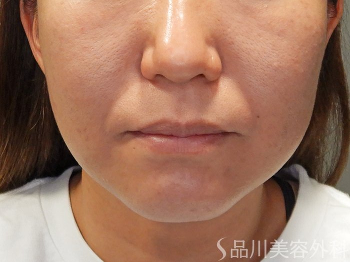 症例NO.69929のBEFORE写真