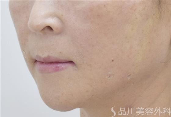 症例NO.49182のAFTER写真