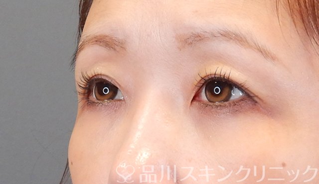 症例NO.75350のAFTER写真