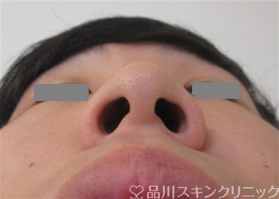 症例NO.32395のBEFORE写真