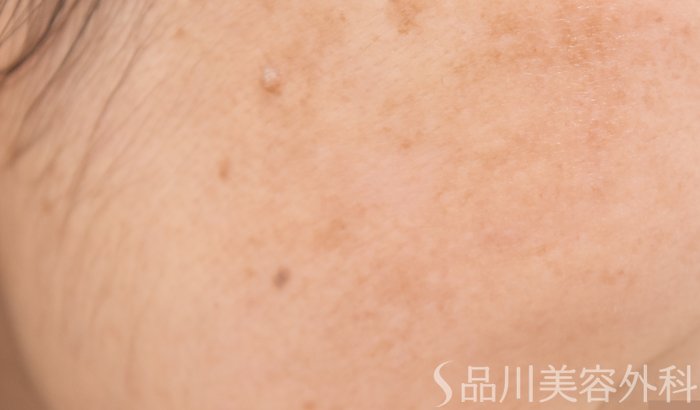 症例NO.64702のAFTER写真