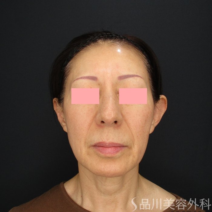 症例NO.70184のBEFORE写真