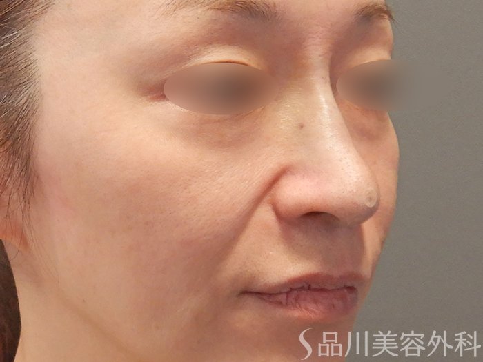 症例NO.70922のAFTER写真