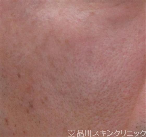 症例NO.33662のAFTER写真