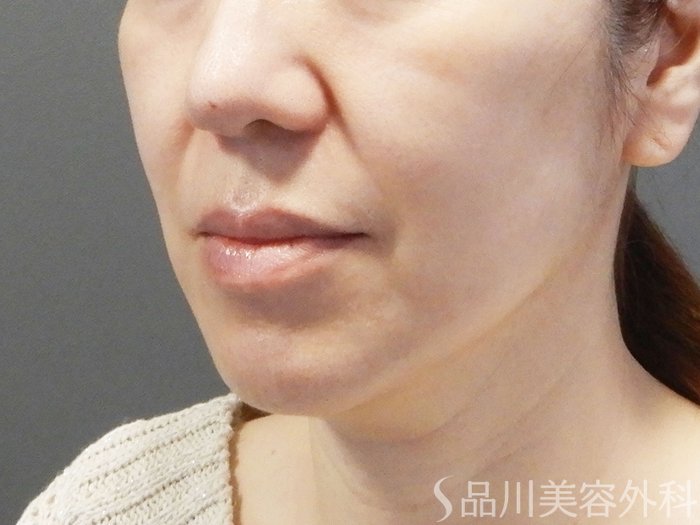 症例NO.75075のAFTER写真