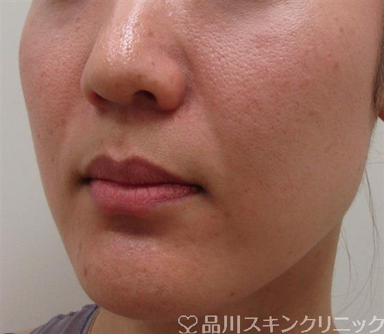 症例NO.32643のBEFORE写真