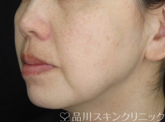 症例NO.70462のBEFORE写真