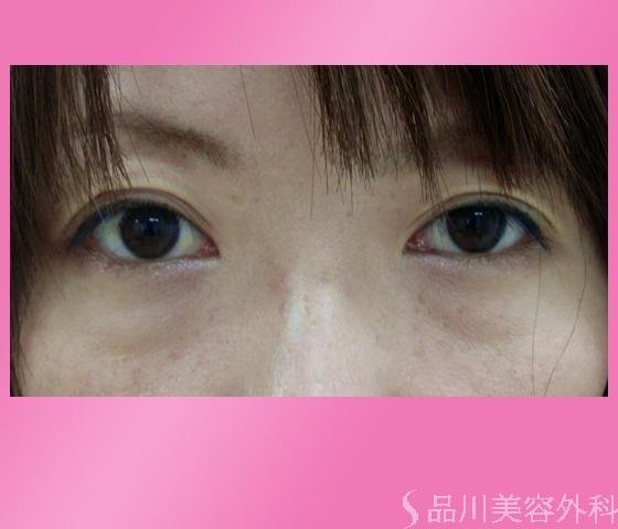 症例NO.1175のBEFORE写真