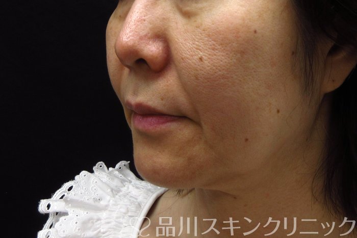 症例NO.74320のBEFORE写真