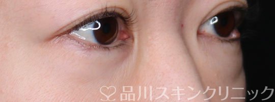 症例NO.70583のBEFORE写真