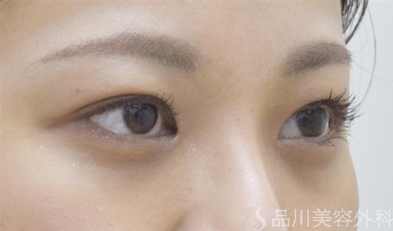 症例NO.45545のAFTER写真