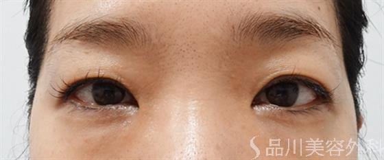 症例NO.52516のBEFORE写真