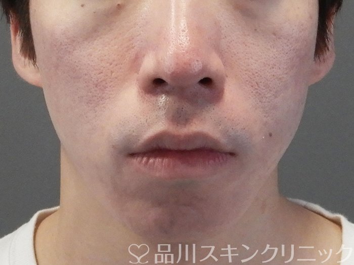 症例NO.69377のAFTER写真