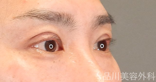 症例NO.75249のAFTER写真