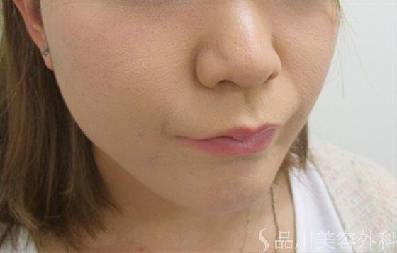 症例NO.27887のAFTER写真