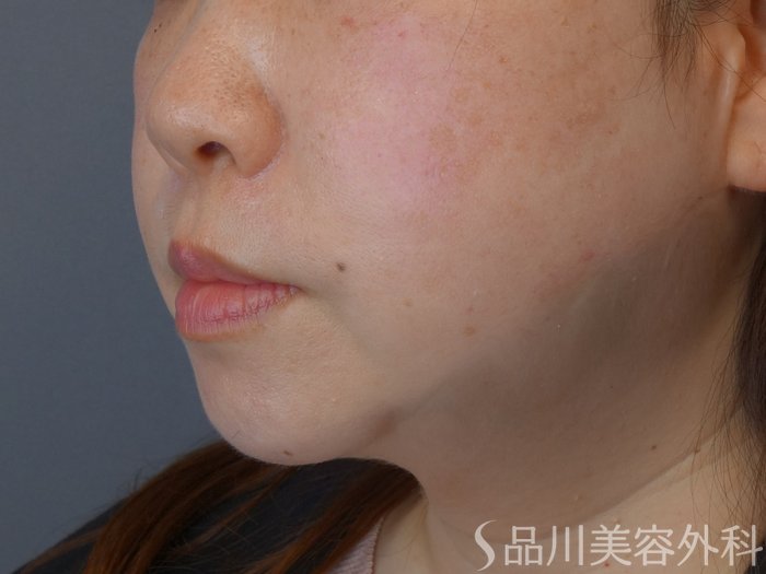 症例NO.73473のAFTER写真