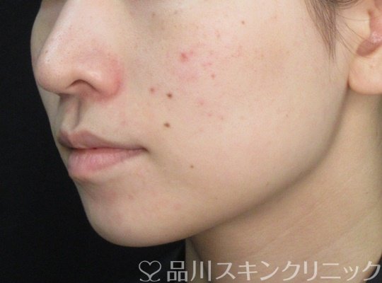 症例NO.70265のAFTER写真