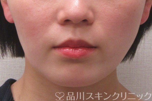 症例NO.75078のBEFORE写真