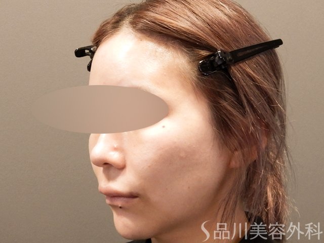 症例NO.67863のBEFORE写真