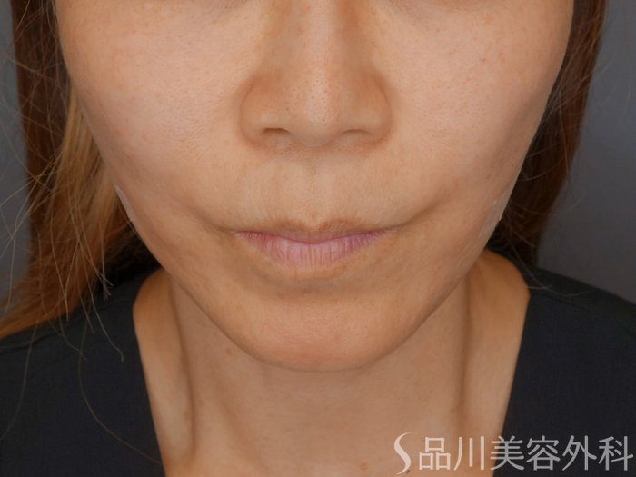 症例NO.71072のAFTER写真