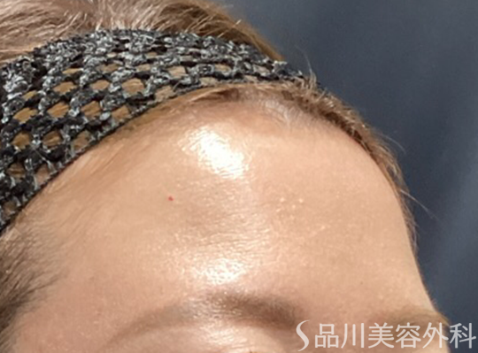 症例NO.74018のBEFORE写真