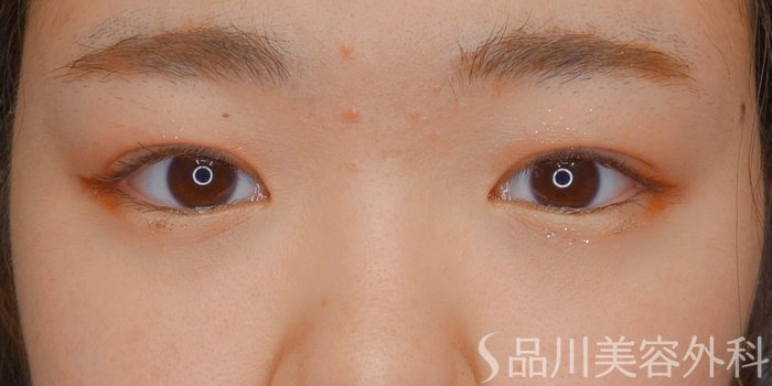 症例NO.73115のAFTER写真