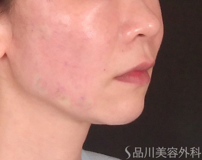 症例NO.70393のAFTER写真