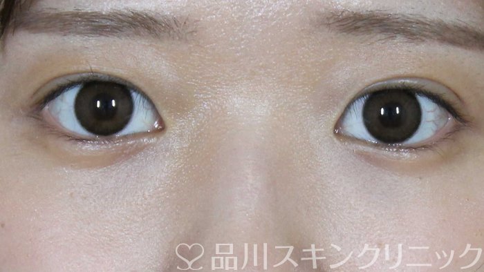 症例NO.72013のAFTER写真