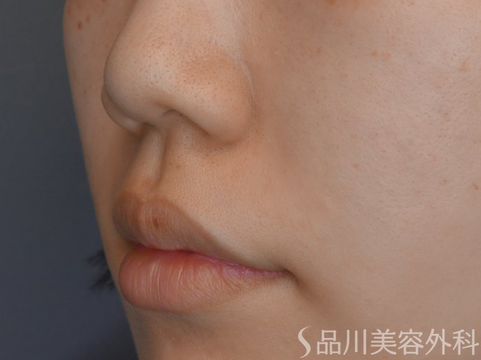 症例NO.70388のAFTER写真