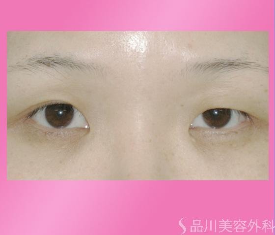 症例NO.815のBEFORE写真