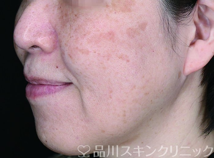 症例NO.70937のBEFORE写真