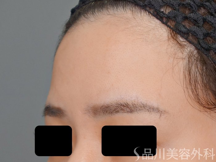 症例NO.69621のBEFORE写真