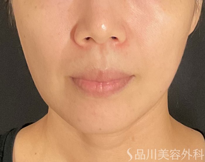 症例NO.74713のBEFORE写真