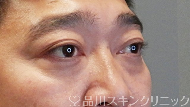 症例NO.65294のAFTER写真