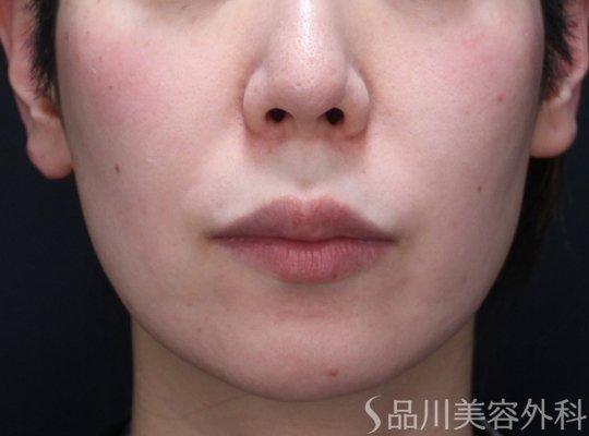 症例NO.73541のBEFORE写真