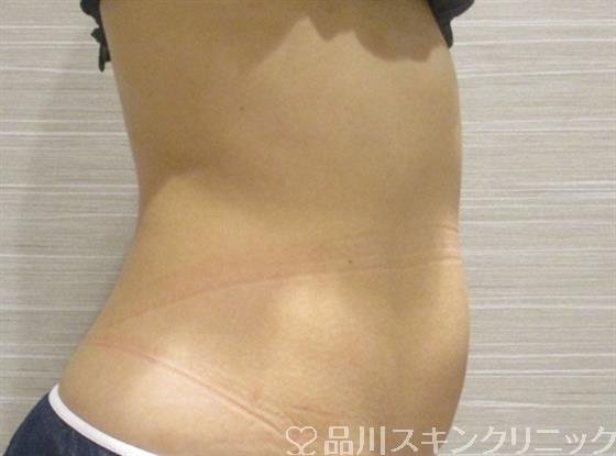 症例NO.36221のAFTER写真