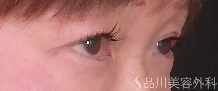 症例NO.70223のBEFORE写真