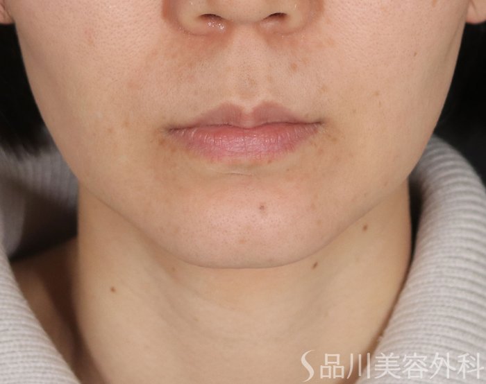 症例NO.72489のBEFORE写真